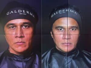 Before and after Sculptra treatment results (clinical photographs courtesy of Galderma)