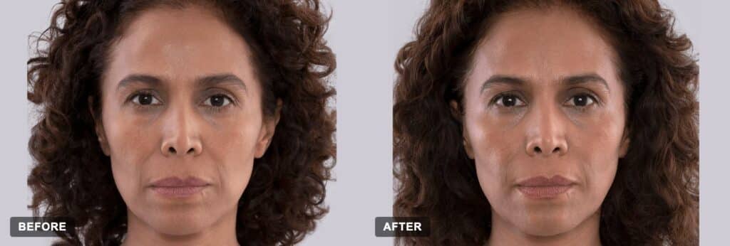 Before and after Sculptra treatment results (clinical photographs courtesy of Galderma)
