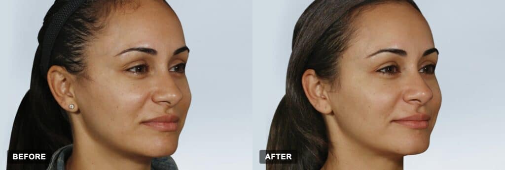 Before and after Sculptra treatment results (clinical photographs courtesy of Galderma)