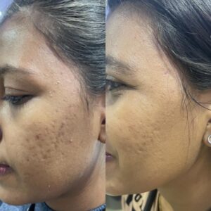 Before and after Profhilo: smoother-looking skin texture on the cheek, Pandit Clinic, Pune