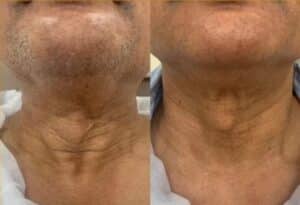 Before and after Profhilo for the neck: reduced crepey skin and improved firmness, Pandit Clinic, Pune