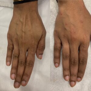 Before and after Profhilo on the back of the hand, showing treatment injection points, Pandit Clinic, Pune