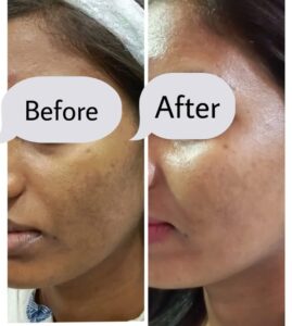 Before and after Profhilo: improvement in skin hydration and texture on the cheek, Pandit Clinic, Pune