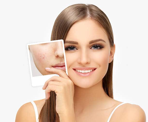 Portrait of girl with problem and clear skin Acne Scar Surgery