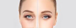 Blepharoplasty