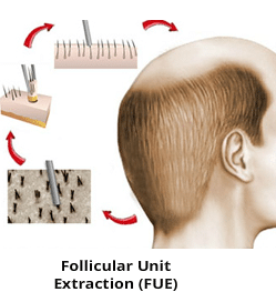 FUE Hair Transplant technique