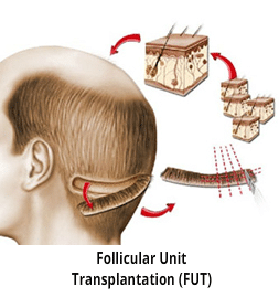 FUT Hair Transplant technique