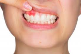 Read more about the article Periodontal / Gum Surgeries