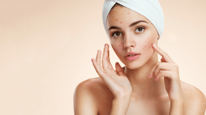 acne treatment