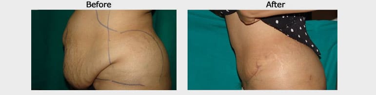 Tummy Tuck