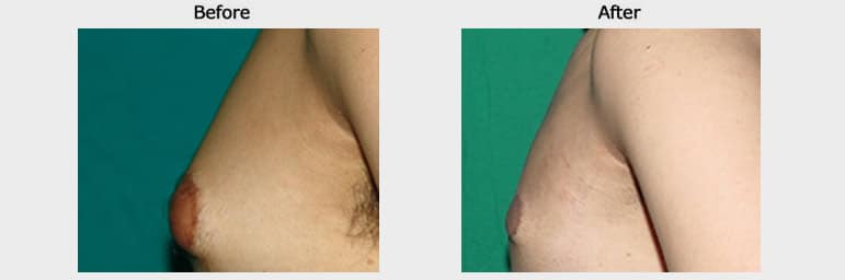 Gynecomastia Surgery Case 3