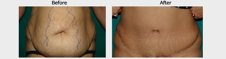 Tummy Tuck