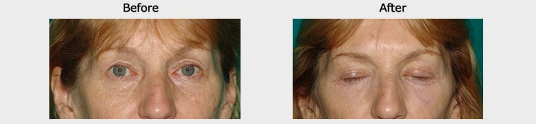 blepheroplasty results