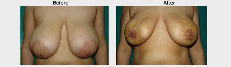 breast reduction case 1