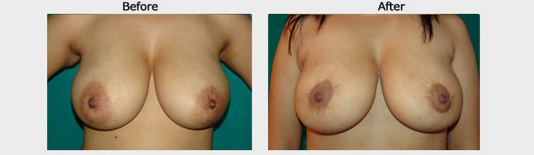 breast reduction