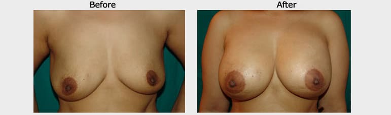 Breast Augmentation