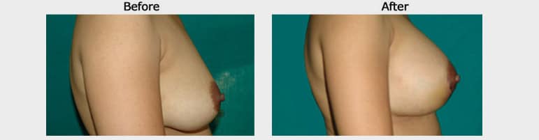 Breast Augmentation