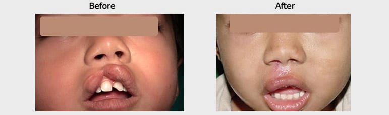 cleft lip result