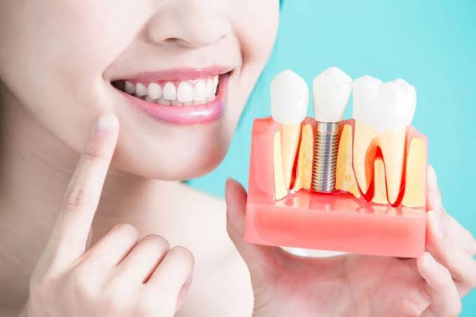 Read more about the article Dental Implants