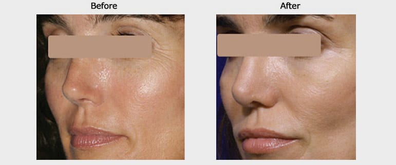 laser skin resurfacing case 1