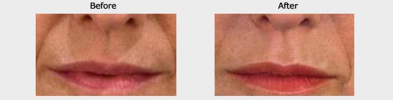 lip augmentation