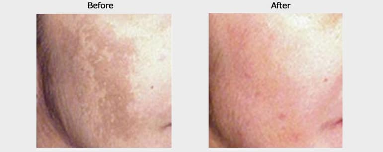 melasma1