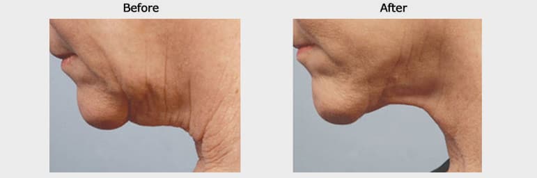 non invasive facelift case 1