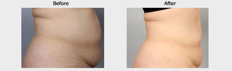 Non invasive fat reduction resultss