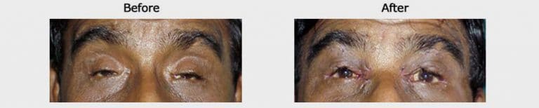 ptosis surgery