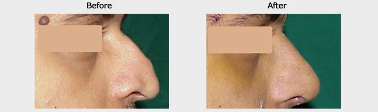 rhinoplasty