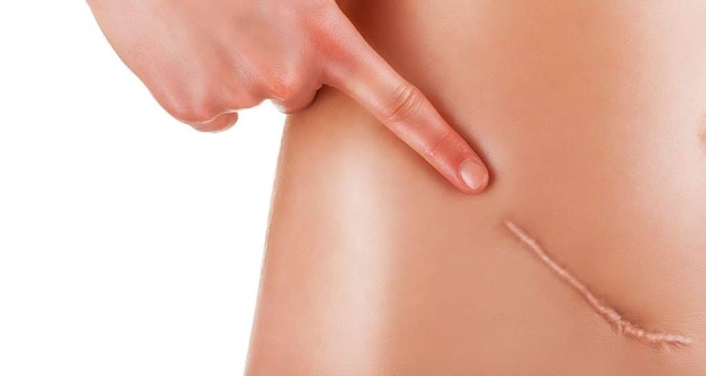 Read more about the article Scar Revision Surgery – Everything You’ve Ever Wanted To Know