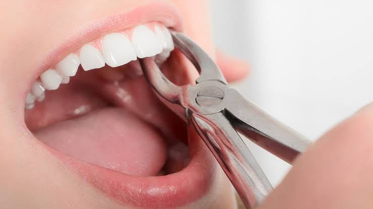 Read more about the article Tooth Extractions