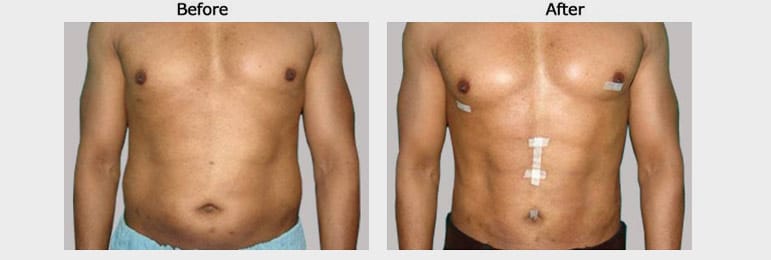 vaser 4d liposuction results