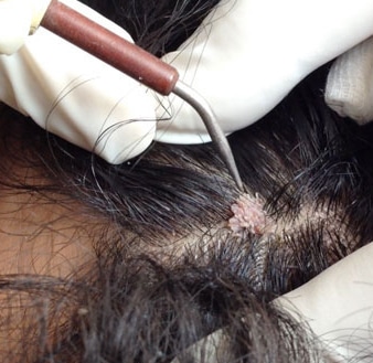 What are warts and skin tags? How are they treated?