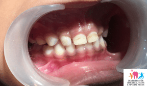 Initial stage of tooth decay