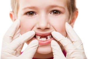 Tooth Decay in kids