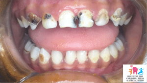 tooth decay in front teeth