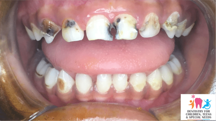 Prevent Tooth Decay in Kids With The Right Oral Care Habits