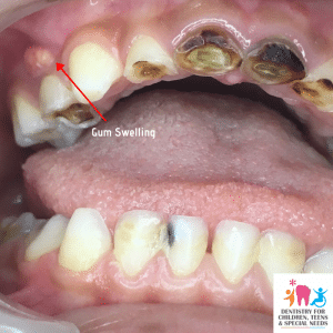 advanced stage teeth cavity and gum swelling