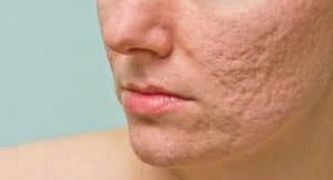 Acne scars