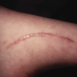 hypertrophic scar