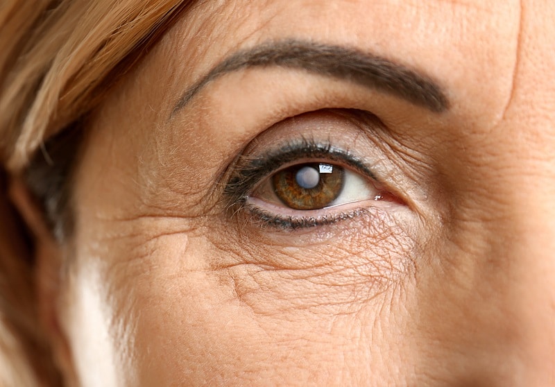 cataract cataract