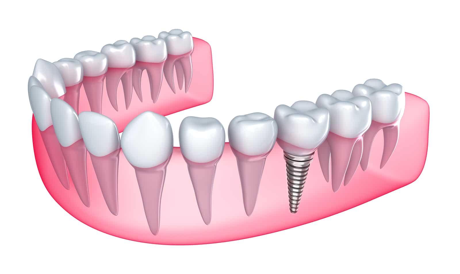 Dental Implants Hero section