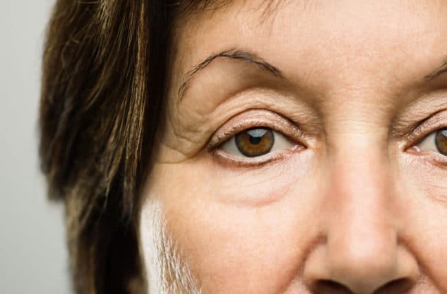 Read more about the article Ptosis Surgery (Drooping Eyelid Surgery)