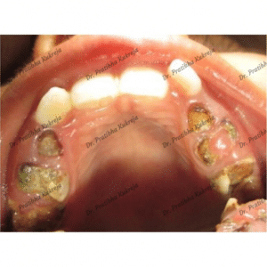 autism - pediatric dentistry