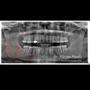 postop cyst removal radiograph