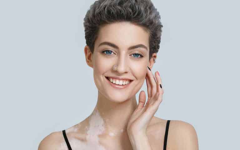 vitiligo vitiligo