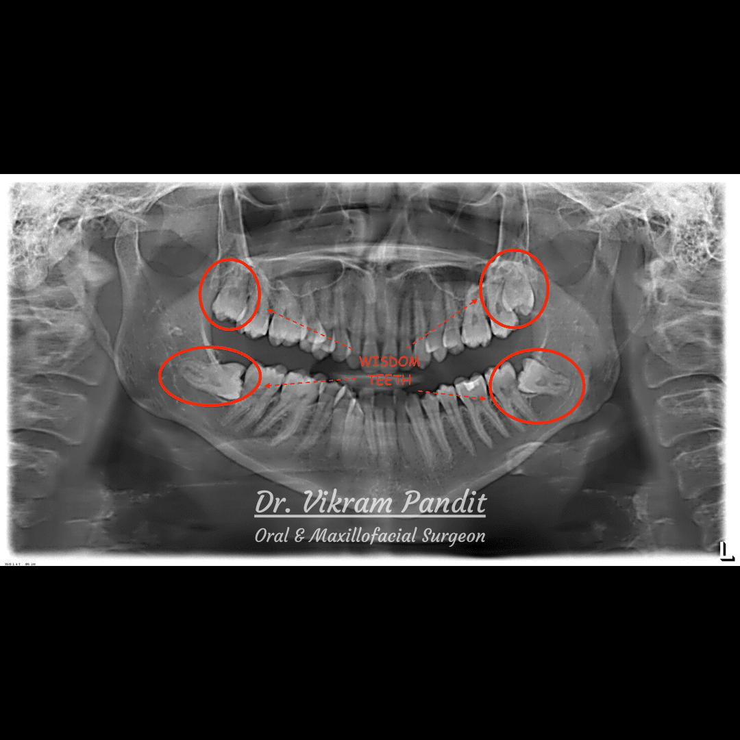 Pandit Wisdom tooth