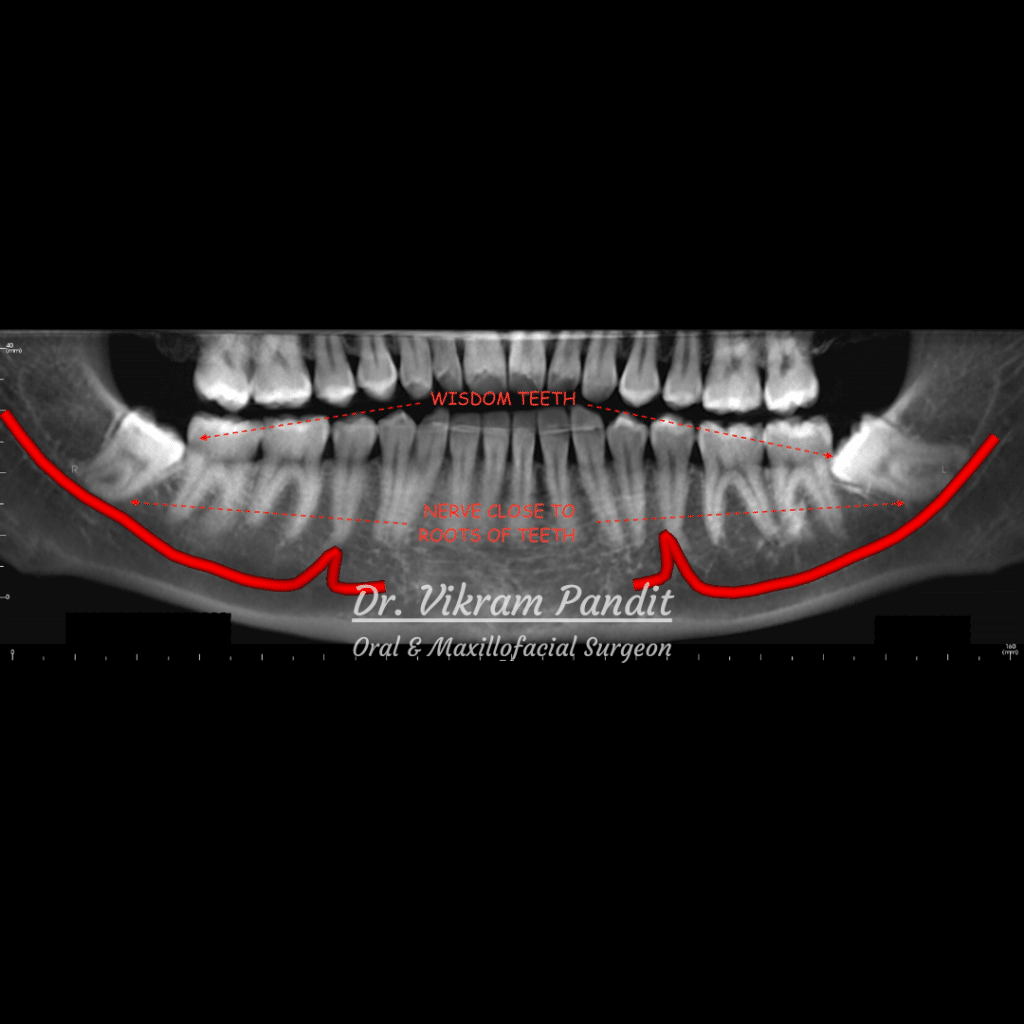 inferior alveolar nerve x ray