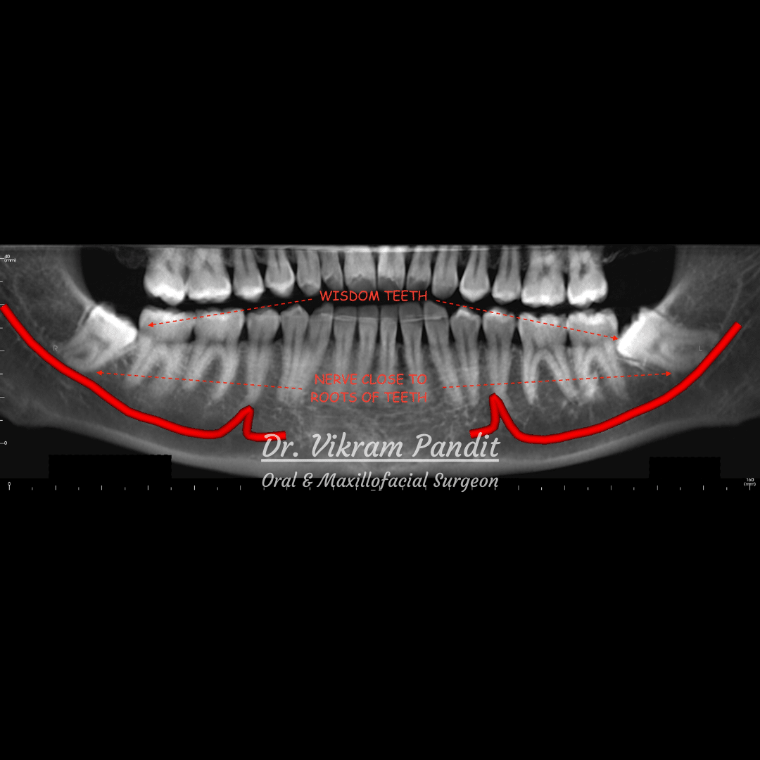 inferior alveolar nerve x ray